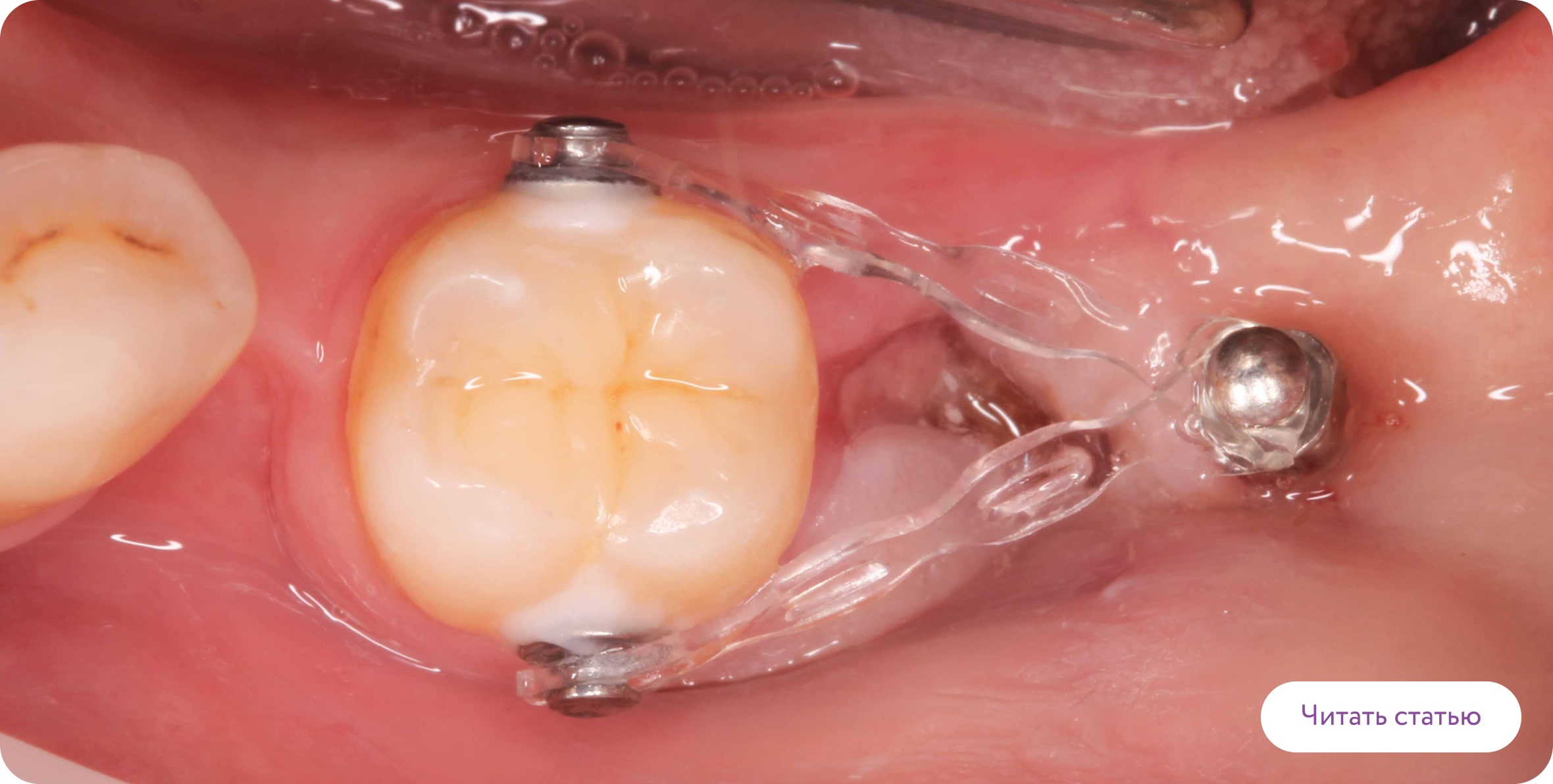 Ортодонтические мини-винты
